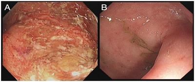 Case report: Fecal microbiota transplant for Clostridium difficile infection in a pregnant patient with acute severe ulcerative colitis